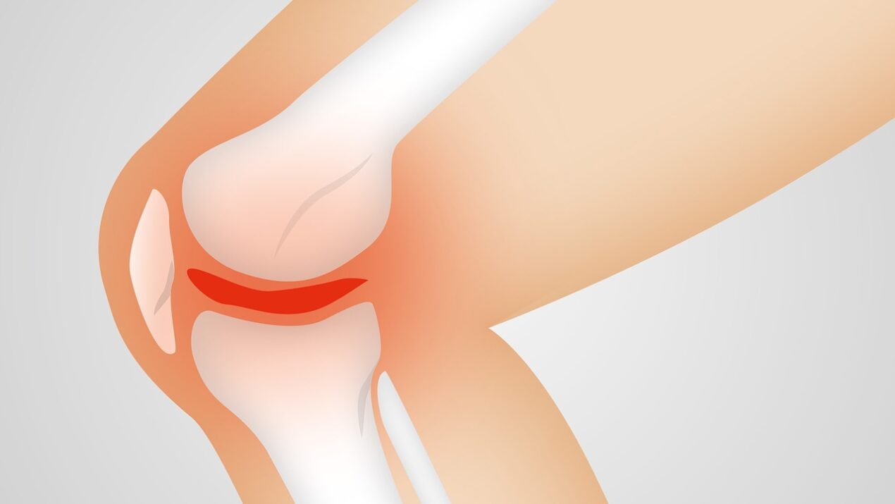 Mewaspadai Osteoarthritis, Nyeri Luar Biasa pada Sendi Lutut