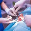 Pengalaman Operasi Impaksi Gigi Bius Total dengan BPJS, Persiapan dan Perawatan Pasca Operasi
