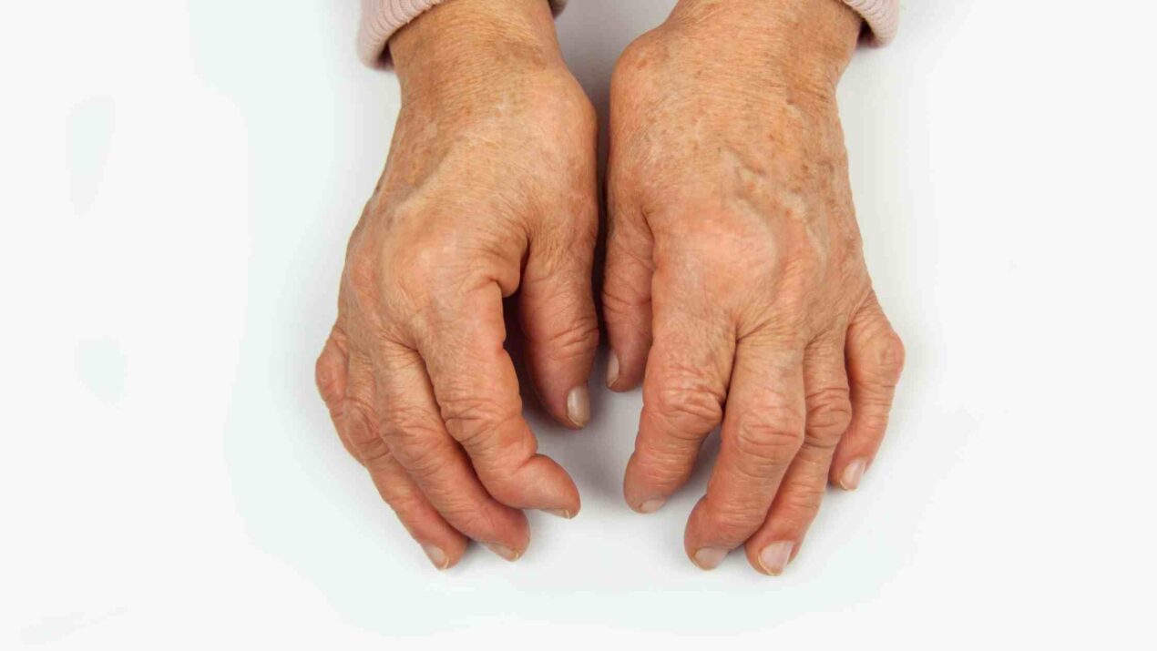 8 Gejala Rheumatoid Arthritis yang Wajib Diwaspadai